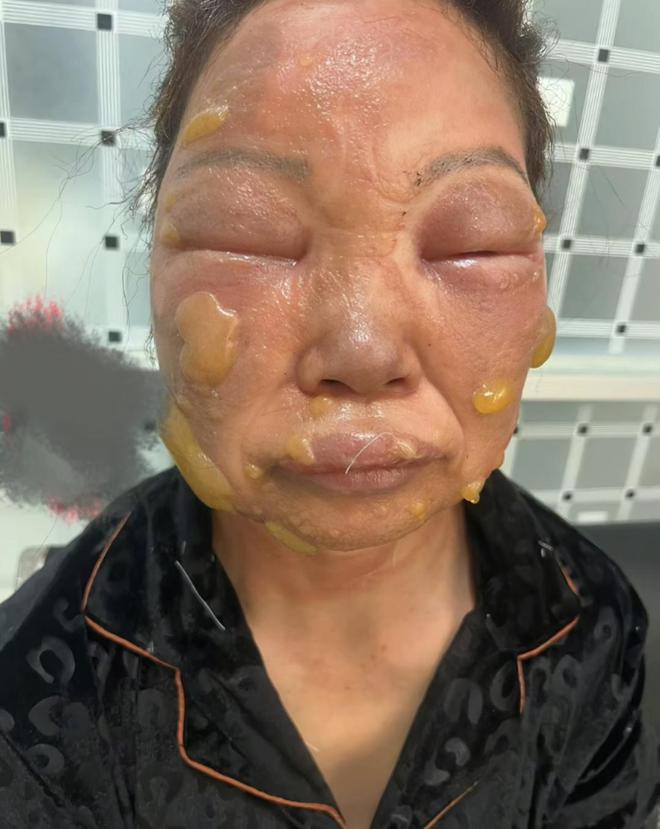 ？网友晒出多人被炸伤图看完不由得冒冷汗pg电子模拟器试玩卡式炉爆炸是有多危险(图2)