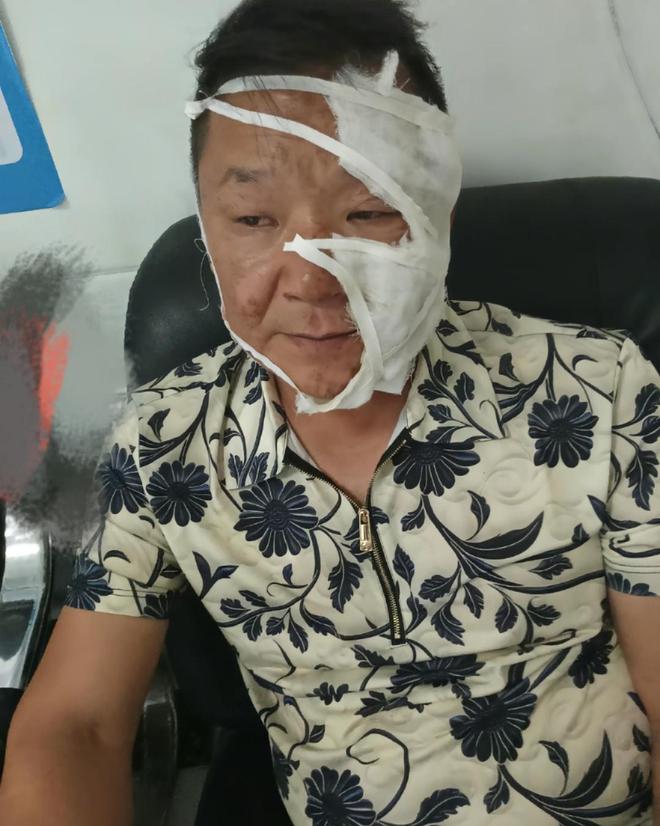 ？网友晒出多人被炸伤图看完不由得冒冷汗pg电子模拟器试玩卡式炉爆炸是有多危险(图5)