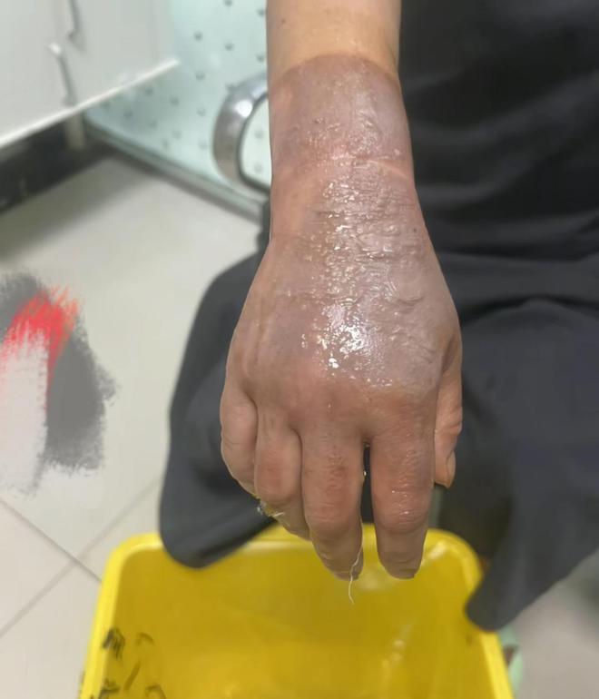 ？网友晒出多人被炸伤图看完不由得冒冷汗pg电子模拟器试玩卡式炉爆炸是有多危险(图9)